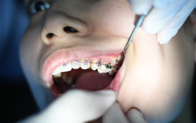 Aparat Dentar Metalic